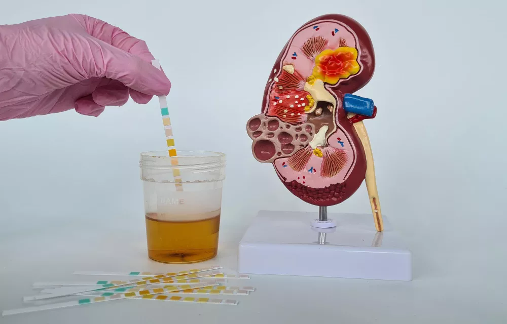 Protein Loss in Urine Treatment