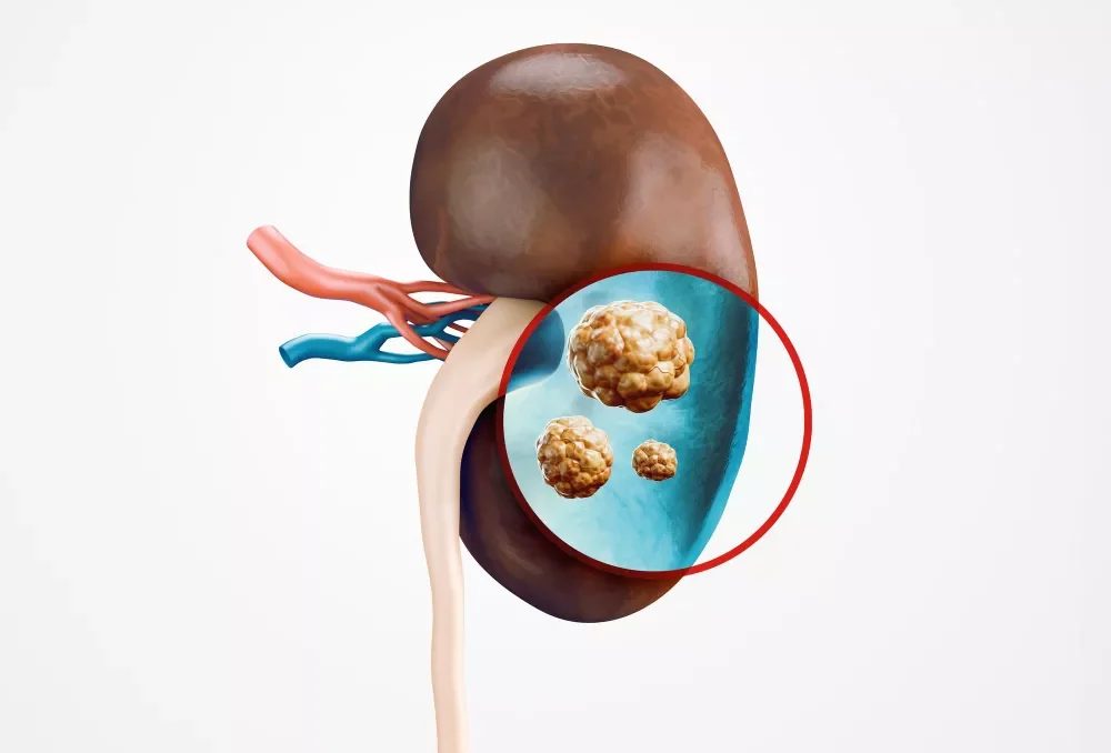 Kidney Biopsy